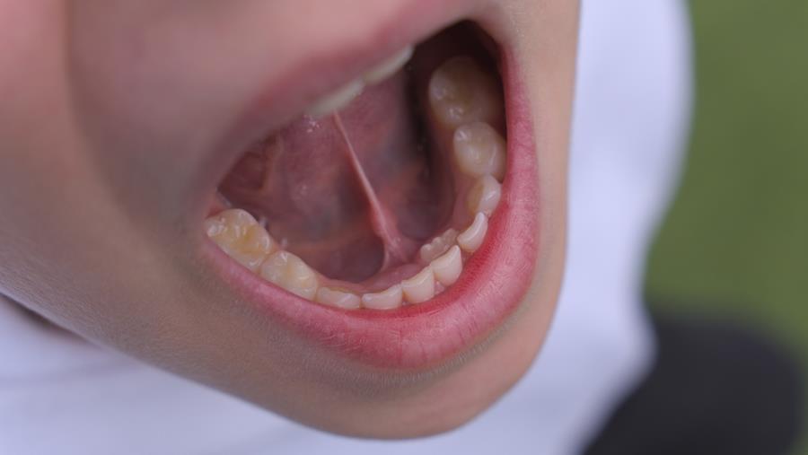 Le KCE va élaborer un guide de pratique clinique pour la frénotomie