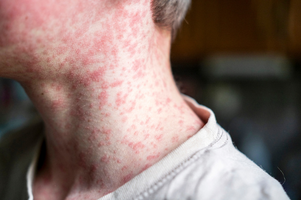Vivalis: 'controleer vaccinatiestatus mazelen voor skivakantie'