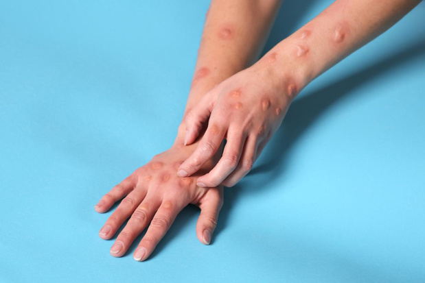 Premiers cas de transmission locale du mpox confirmés sur le territoire européen de l'OMS
