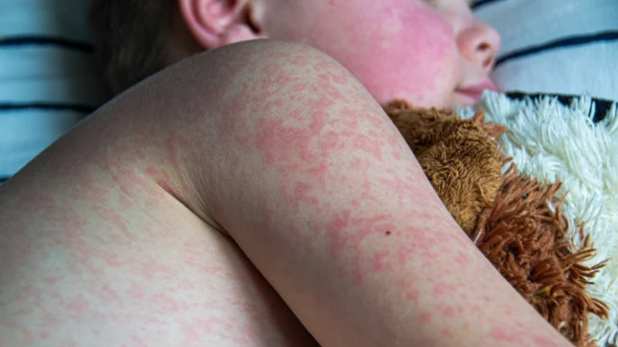 Mazelen: N-VA pleit voor vaccinatiegegevens op niveau van postcodes