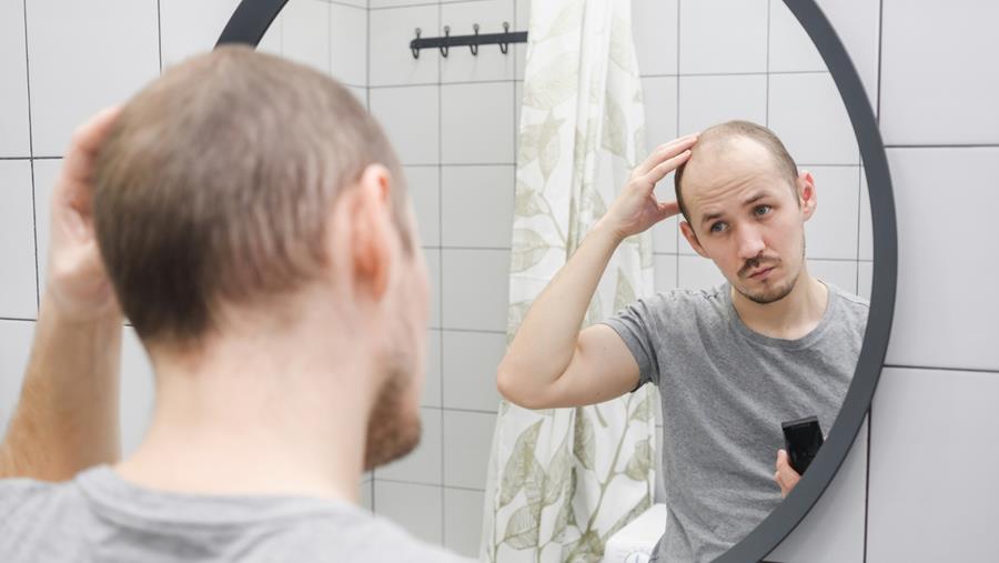 Minoxidil per os versus minoxidil topisch